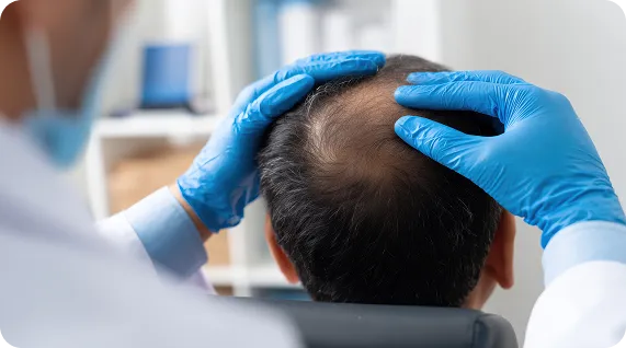 Conditions Addressed by Hair Fall Treatment - Xelix