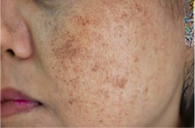 Pigmentation
