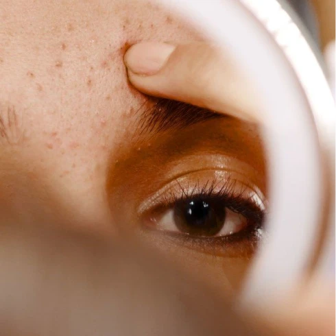 Acne Scar Solutions